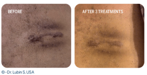 keloid scars treatment before after